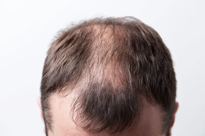 A Complete Guide to Male Hair Loss and Alopecia